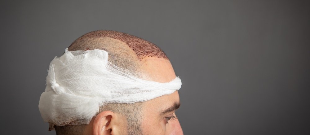 Hair Transplant
