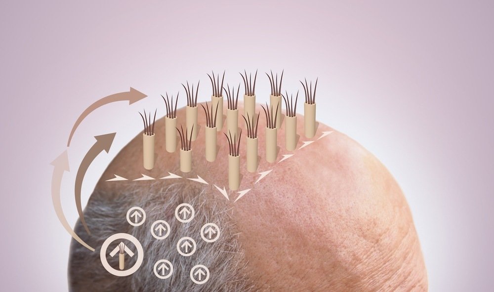 Hair Graft